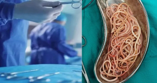 नोएडा: 4 वर्षीय बच्ची के पेट से निकले सैकड़ों कीड़े, जिम्स के डॉक्टरों ने ऑपरेशन कर बचाई जान